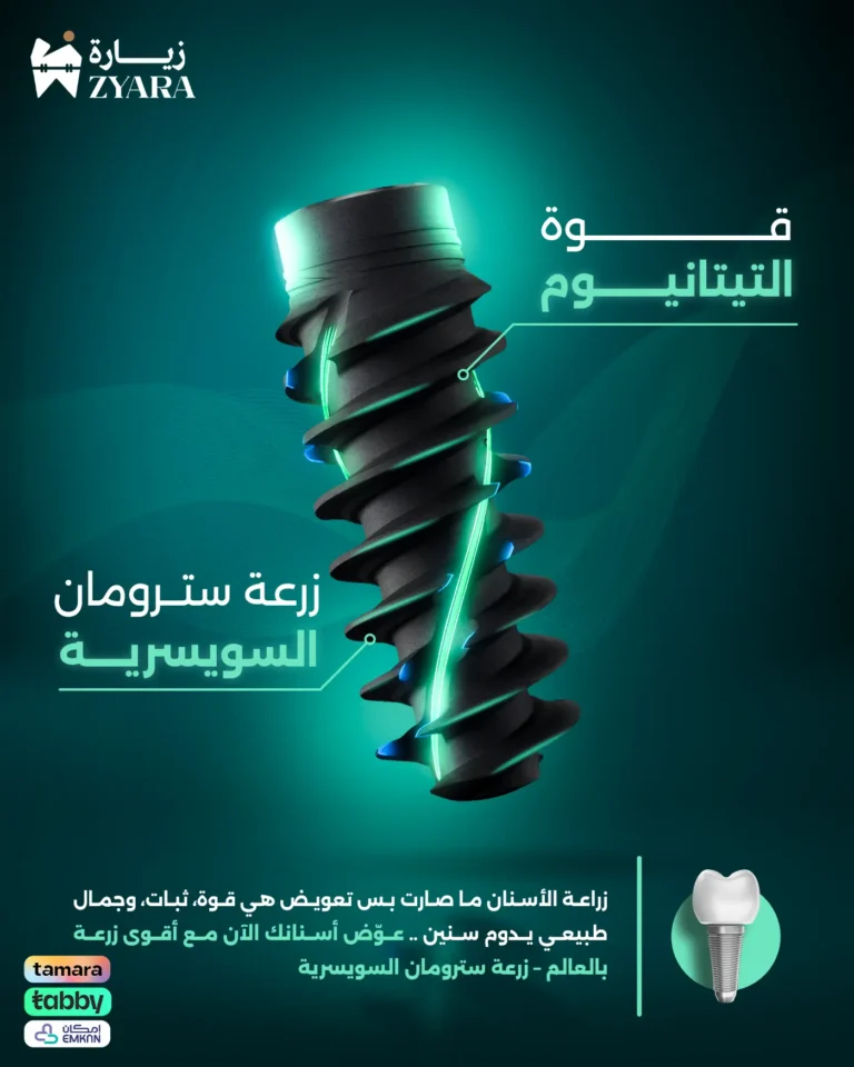 استعراض قوة التيتانيوم في زرعة سترومان السويسرية، لتعويض الأسنان بثبات وجمال طبيعي يدوم طويلاً في مجمع زيارة، أفضل عيادة أسنان في خميس مشيط.
