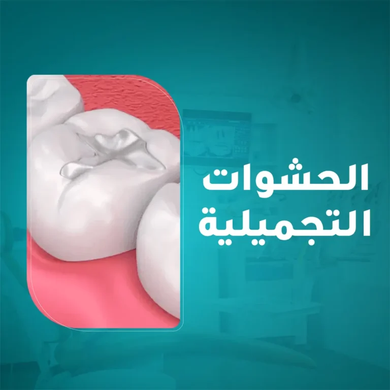 علاج تسوس الأسنان باستخدام أحدث الحشوات التجميلية المطابقة للون السن الطبيعي في مجمع زيارة، أفضل عيادة أسنان في خميس مشيط.