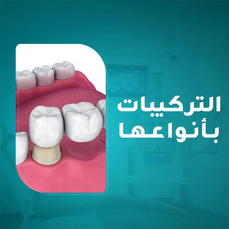 تعويض الأسنان المفقودة بأجود التركيبات السنية الثابتة والمتحركة لإعادة تأهيل الفم في مجمع زيارة، أفضل عيادة أسنان في خميس مشيط.